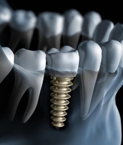 Dental Implants